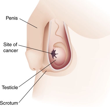 imagine cu cancerul testicular
